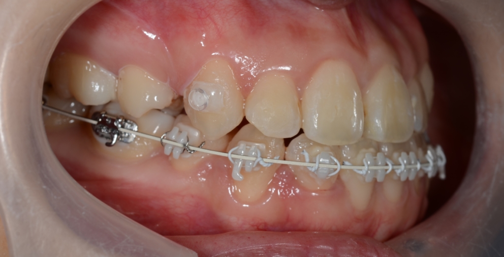 マルチブラケットシステムで矯正治療。 上顎は裏側矯正を用いたハーフリンガル
