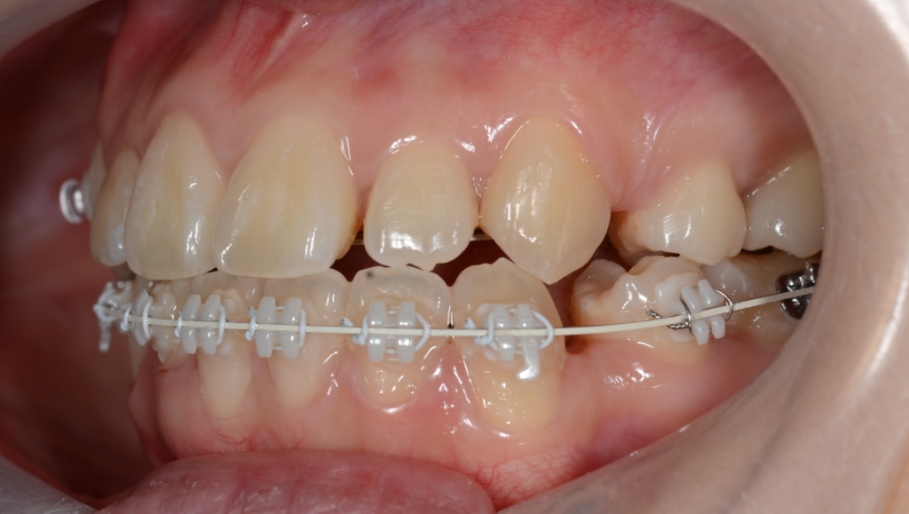 マルチブラケットシステムで矯正治療。 上顎は裏側矯正を用いたハーフリンガル
