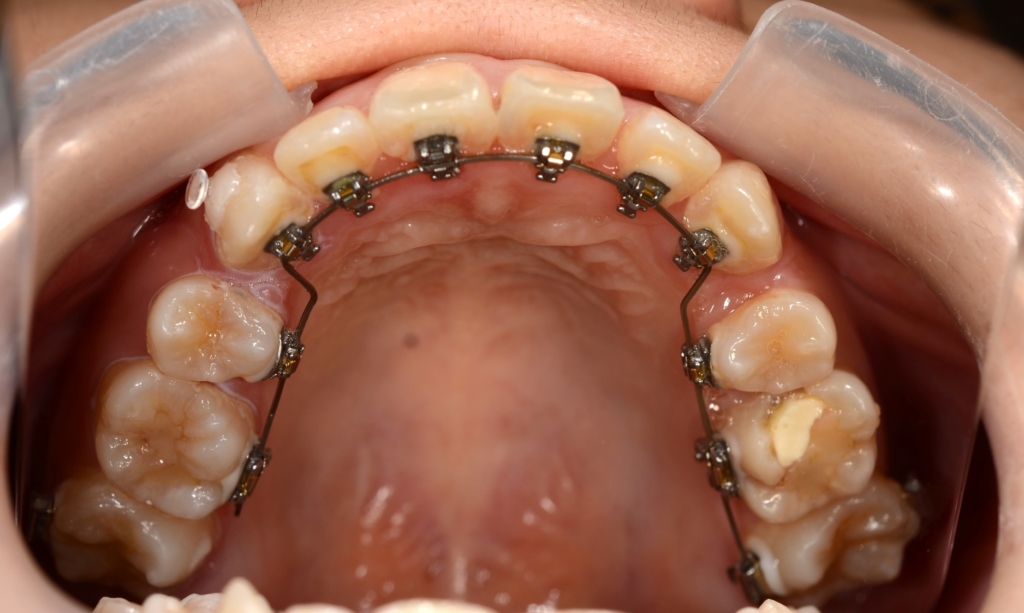 マルチブラケットシステムで矯正治療。 上顎は裏側矯正を用いたハーフリンガル