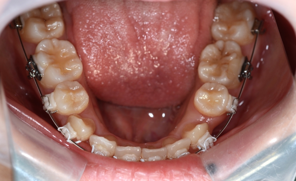 マルチブラケットシステムで矯正治療。 上顎は裏側矯正を用いたハーフリンガル