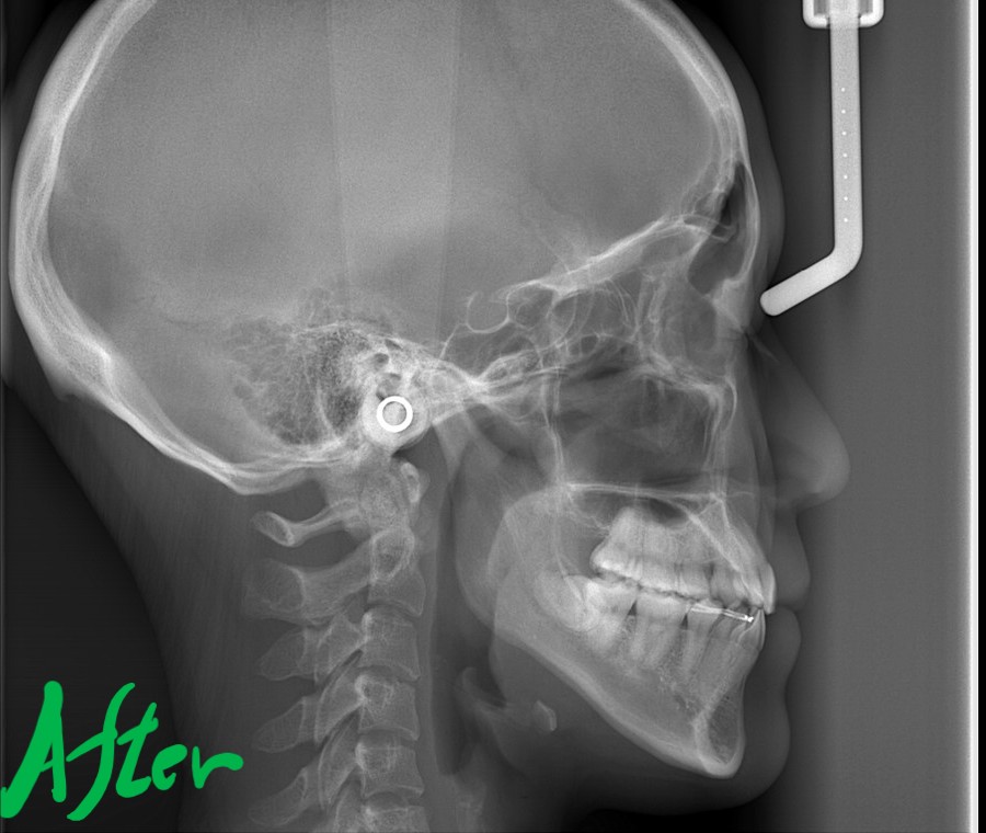 八重歯で反対咬合を矯正した後の頭部を横から見たレントゲン写真