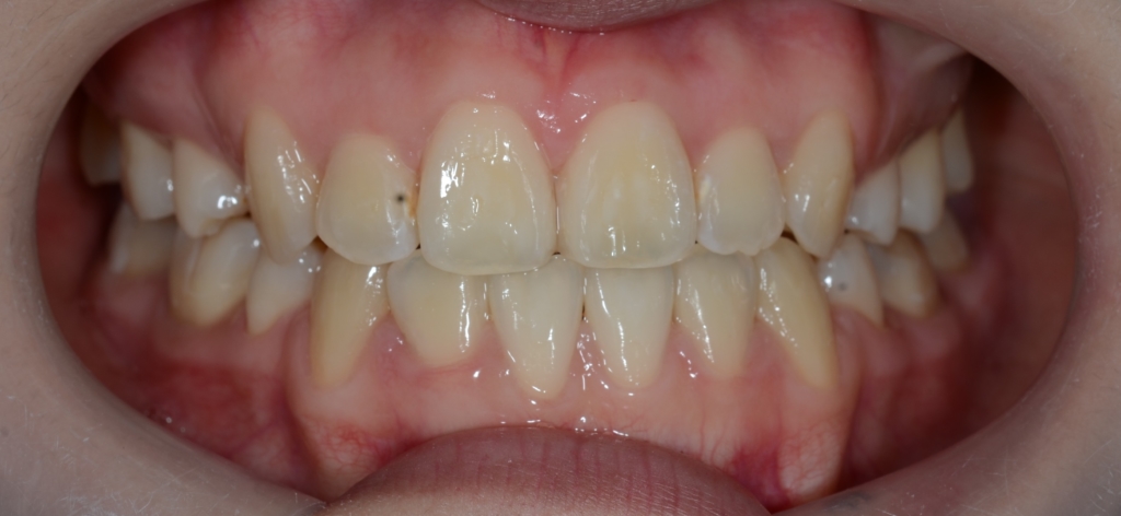 八重歯で反対咬合を矯正した後の歯並び