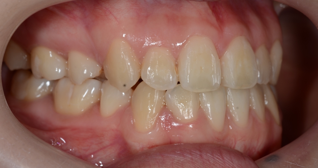 八重歯で反対咬合を矯正した後の歯並び