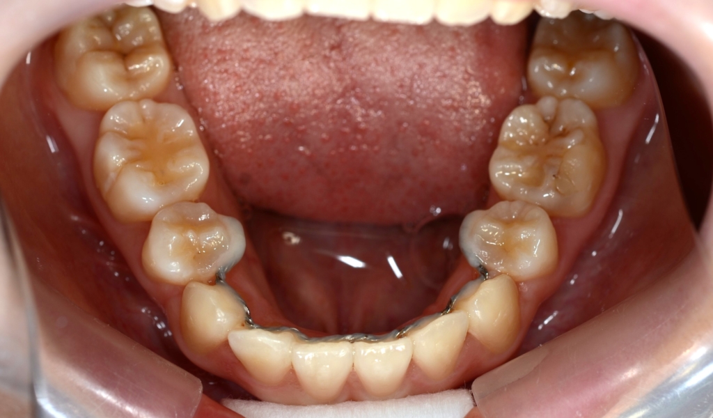 八重歯で反対咬合を矯正した後の歯並び