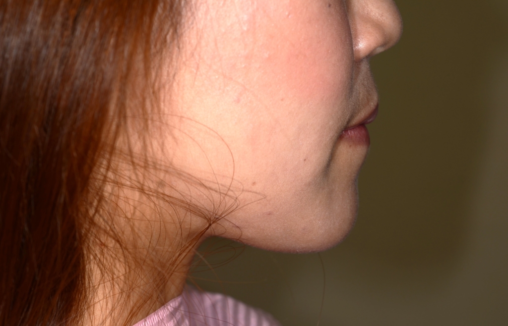 八重歯で反対咬合を矯正した後の横顔と口元