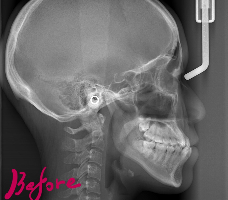 八重歯で反対咬合を矯正する前の頭部を横から見たレントゲン写真