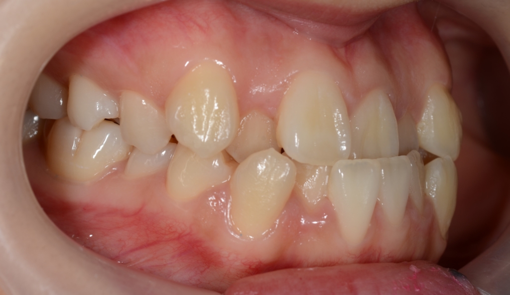 八重歯で反対咬合を矯正する前の歯並び