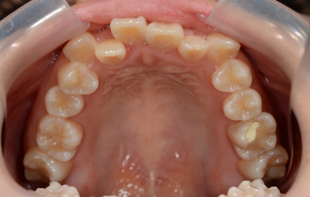 八重歯で反対咬合を矯正する前の歯並び