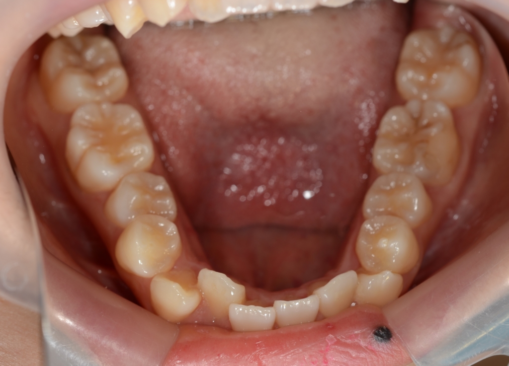 八重歯で反対咬合を矯正する前の歯並び