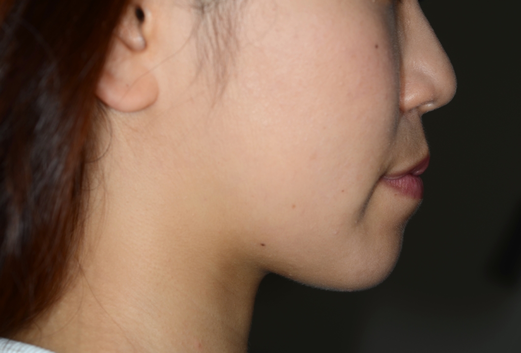 八重歯で反対咬合を矯正する前の横顔と口元