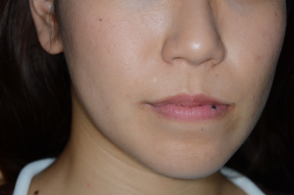 八重歯で反対咬合を矯正する前のお顔の正面観