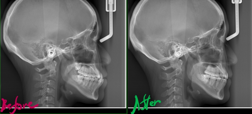 八重歯で反対咬合を矯正した治療前後のレントゲン写真による比較