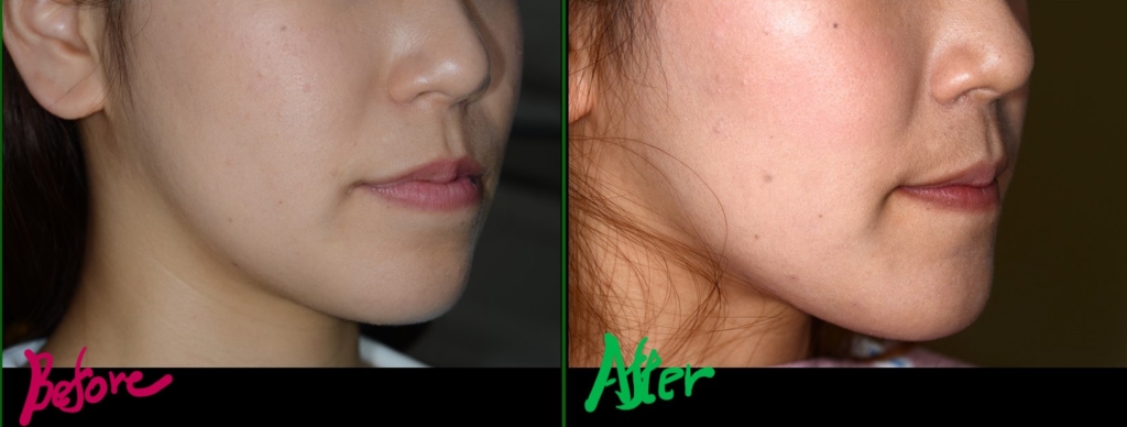 八重歯で反対咬合を矯正した治療前後の横顔と口元の変化の比較