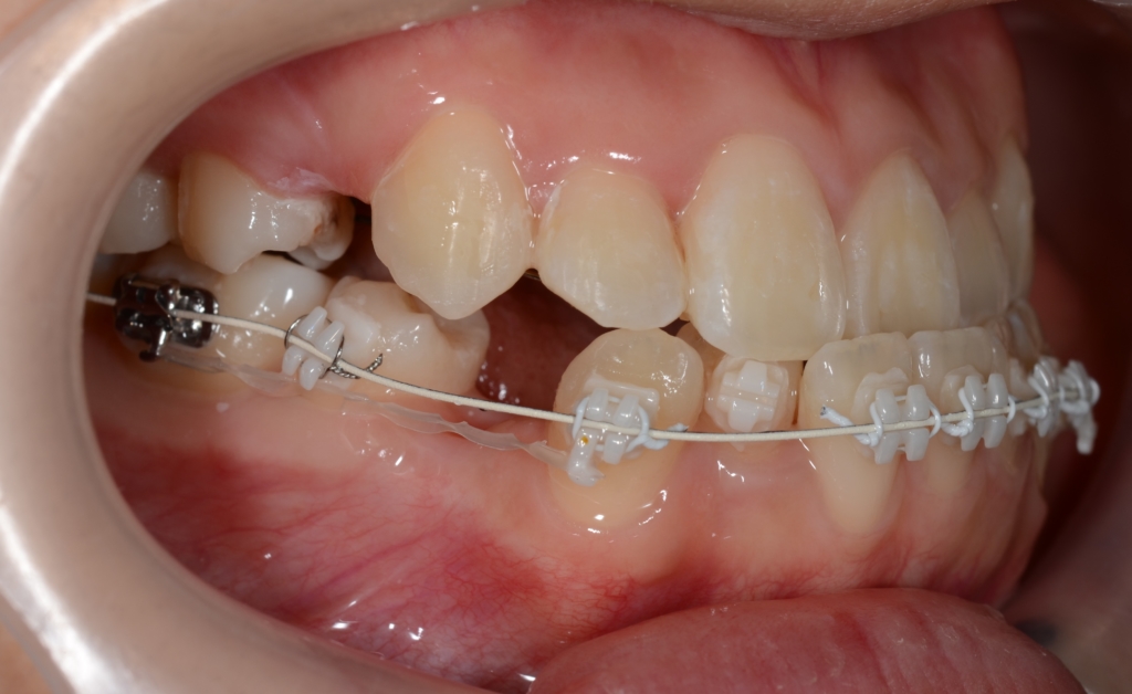 マルチブラケットシステムで矯正治療開始 上顎は裏側矯正を用いたハーフリンガル