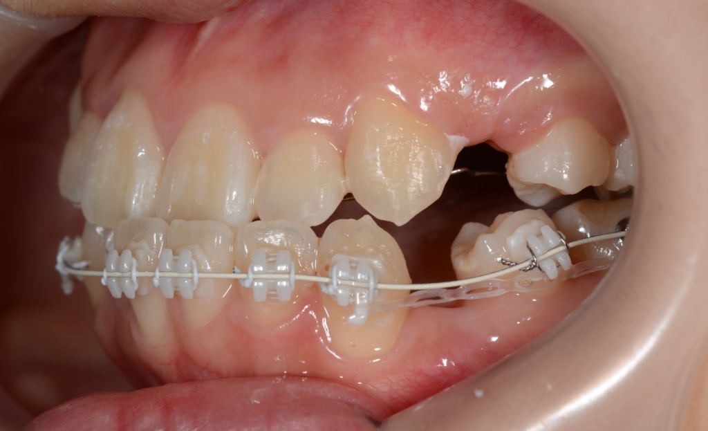マルチブラケットシステムで矯正治療開始 上顎は裏側矯正を用いたハーフリンガル
