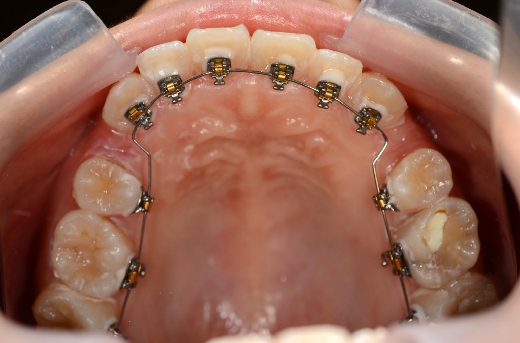 マルチブラケットシステムで矯正治療開始 上顎は裏側矯正を用いたハーフリンガル